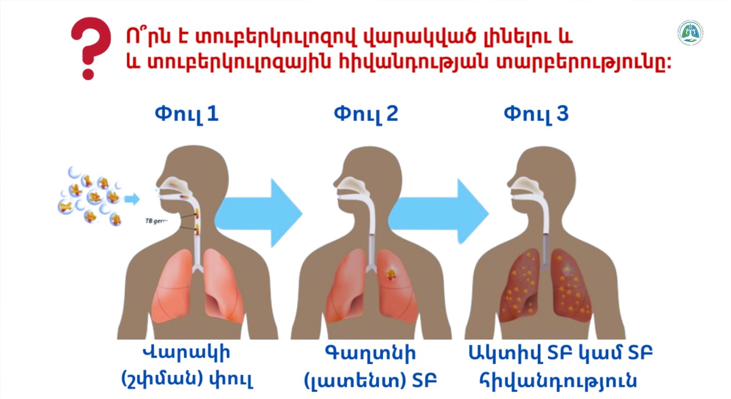 Stages of Tuberculosis